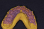 Figure 7. Surgical index fabricated on study
cast carrying information for desired gingival levels.