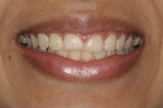 Figure 2. Preoperative frontal smile view.