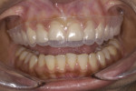 Figure 12. Clear prep guide depicts tooth preparation based on final volume of the restorations.