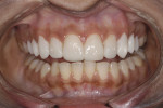 Figure 11. View showing first provisionals fabricated from the wax-up before tooth preparations.