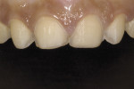 Figure 13. Tooth preparations showing final margin placements in relation to gingival crest.