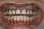 Figure 14. No. 000 cord impregnated with buffered aluminum chloride to provide transient retraction of gingival tissues.