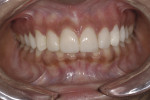 Figure 16. Final provisionals fabricated directly on the prepared teeth.
