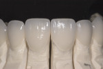 Fig 17. Feldspathic veneers on models depicting the form, translucency, and texture of anterior teeth.