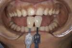 Figure 15. Stump shades for color reference of prepared teeth.