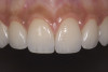 Fig 7. Erosion of the facial maxillary central incisor.