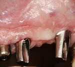 Figure 4  In the absence of attached gingiva, tissue adjacent to an implant can remain healthy (site No. 12).