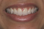Figure 20. Postoperative frontal smile view.