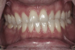 Figure 3. Class 3 bite with anterior crossbite was evident in this preoperative photograph.