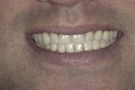 Figure 2. Pre-treatment full smile showed the patient was moderate risk dentofacially due to
partial gingival display.