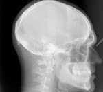 Figure 10. Post-orthodontic cephalometric
radiograph.
