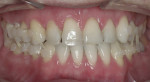 Figure 8. The transitional bonding was also effective in improving communication between the general dentist and orthodontist.