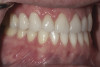 Fig 15. After healing, the gingiva around the emergence custom healing abutment was ready for initiation of the restorative phase of treatment.