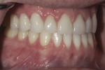 Figure 11 through Figure 13. Natural-appearing restorations had predictable interproximal contacts at cementation—right lateral view (Fig 11).