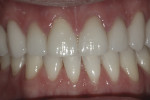 Figure 11 through Figure 13. Natural-appearing restorations had predictable interproximal contacts at cementation—front view (Fig 13).