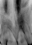 Figure 1 and Figure 2. Representative periapical radiographs taken at initial presentation, which was 10 days post-trauma.
