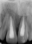 Figure 8. Post-obturation periapical radiograph taken 20 days post-trauma.