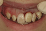 Figure 5 and Figure 6. Intraoral photographs taken after re-extraction and replantation of tooth No. 9 and physiologic splinting of teeth Nos. 6 through 11.