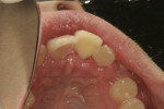 Figure 3 and Figure 4. Intraoral photographs taken at initial presentation (10 days post-trauma).