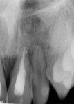 Figure 9 and Figure 10. Periapical radiographs exposed 38 days post-trauma showing possible periapical pathology associated with tooth No. 10.