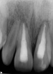 Figure 9 and Figure 10. Periapical radiographs exposed 38 days post-trauma showing possible periapical pathology associated with tooth No. 10.