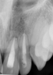 Figure 11 and Figure 12. Periapical radiographs exposed about 10 weeks post initial trauma exhibiting slight apical resorption on teeth Nos. 8 and 9, with widened periodontal ligament spaces.