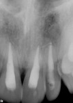 Figure 16 and Figure 17. Periapical radiographs exposed 1 year and 16 weeks post initial trauma. Teeth Nos. 8 and 9 exhibited arrested resorption and apical healing.