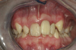 Figure 13 through Figure 15. At about 21 weeks post initial trauma tooth No. 10 was determined to have periapical pathology, as seen in periapical radiographs (Fig 13 and Fig 14); intraoral photograph (Fig 15) showed arrested root resorption apically on teeth Nos. 8 and 9.