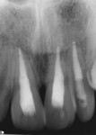 Figure 16 and Figure 17. Periapical radiographs exposed 1 year and 16 weeks post initial trauma. Teeth Nos. 8 and 9 exhibited arrested resorption and apical healing.