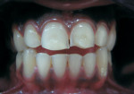 Figure 1. A patient exhibiting dental erosion associated with swimming.