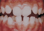 Figure 2. Fracture of incisal edges is common among competitive swimmers.