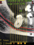 Figure 1 CBCT radiograph shows the actual proximity between the third molar roots and the alveolar nerve.