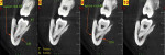 Figure 2 CBCT radiograph shows the actual proximity between the third molar roots and the alveolar nerve.