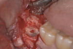 Figure 5 After the crown removal, the third molar root was reduced using a round bur in a high-speed surgical drill so that the remaining root fragments were at least 3 mm to 4 mm below the crest of the lingual and buccal plates.