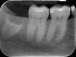 Figure 9 Periapical radiograph 12 months after surgery.