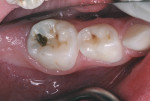 Figure 2 Mandibular right primary molars.