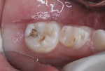 Figure 3 Mandibular left primary molars.