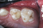 Figure 9 Occlusal pit and disto–occlusal interim restoration, 26 months after treatment.