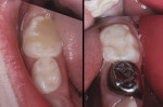 Figure 10 Mandibular molars, 26 months after treatment.