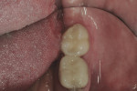 Figure 2 The distal–lingual portion of the layered porcelain had sheared away from the underlying zirconia coping.