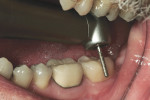 Figure 6 The 4ZR™ diamond bur was used to section the layered porcelain and zirconia coping from lingual to buccal, across the occlusal surface.