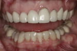 Figure 2 Photograph of the preoperative condition. The patient desired improved function and esthetics.
