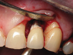 Figure 5  Excess cement noted below the crown margin resulting in peri-implant inflammation as shown in Figure 3. After facial and palatal flap elevation for direct visualization, excess cement was removed with curettes. Care was taken to avoid scrat