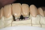 Figure 12 The incisal area was cut back to allow room for micro-layering of the incisors.