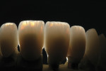 Figure 15 The internal effects and natural opalescence of the lithium-disilicate restorations were clearly visible when backlit.