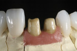 Figure 18 The abutments esthetically matched the natural tooth structure