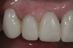 Figure 6 A gingival deficiency between teeth Nos. 7 and 8 required the use of pink ceramic. A pink composite piece was fabricated chairside to communicate the color and size of the desired papilla.