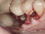 Figure 1 Severe bone loss caused by implant cement migrating down along the implant surface.