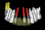 Figure 4 With the maxillary bone removed, the realistic implants, abutments, and translucent virtual teeth were revealed in proximity to the
natural tooth roots.