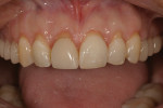 Figure 3 View after esthetic and functional crown